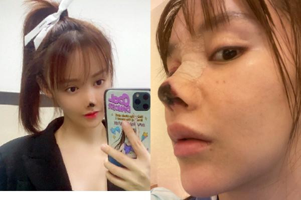 Showbiz 12/4: Nữ diễn viên xinh đẹp bị ‘biến dạng’ mặt vì phẫu thuật thẩm mỹ