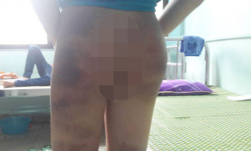 Em Hà Nam sau khi bị đánh.