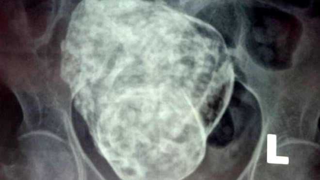 Hình ảnh khối thai đá trong cơ thể bà Sáu