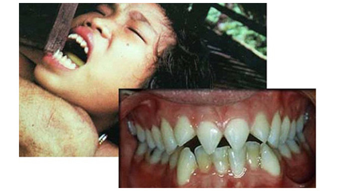 Cận cảnh quá trình mài răng