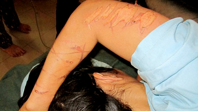 Những vết thương ở khắp cánh tay sau khi bị tra tấn