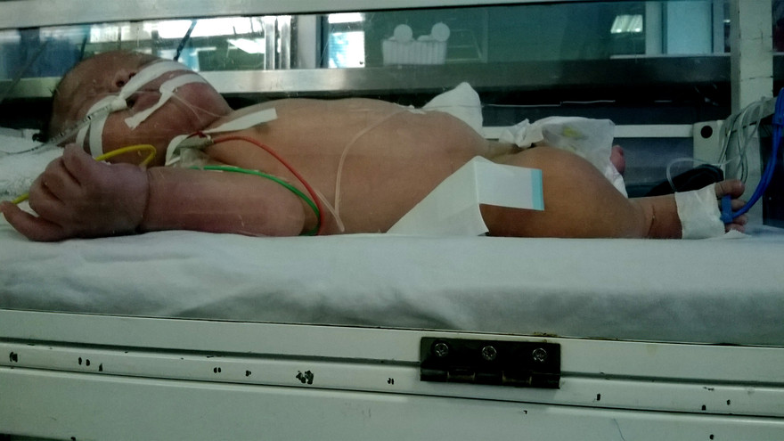 Bé Khuất Tiến Minh được điều trị tại khu vực cách ly, các bác sĩ đang chăm sóc rất tích cực.