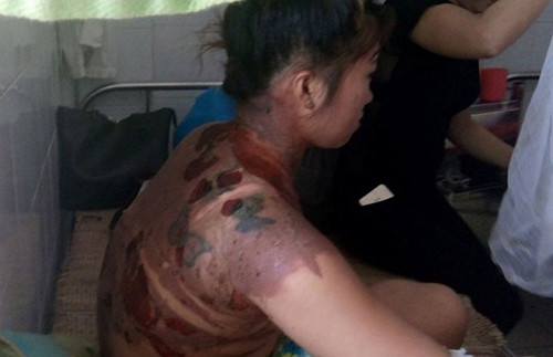Chị V. với nhiều vết bỏng khắp cơ thể. Ảnh: Lam Sơn.