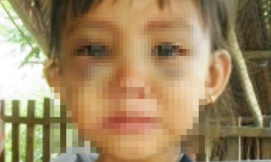 Bé Vy với đôi mắt bầm tím, nghi bị bạo hành