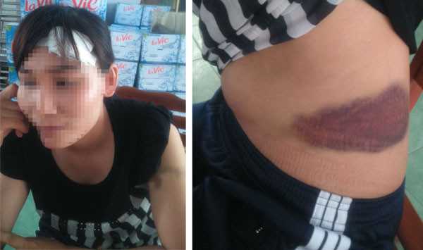 Vết thương trên đầu rách, khâu 5 mũi và bên hông chị Thương