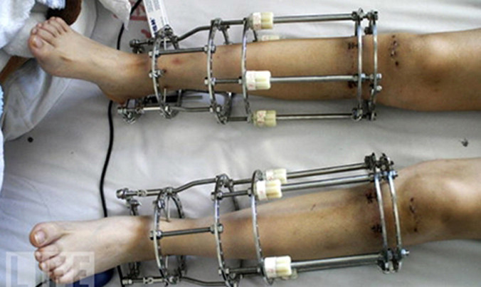 Ngành công nghiệp kéo dài chân cho phái đẹp đang ăn nên làm ra ở Ấn Độ.