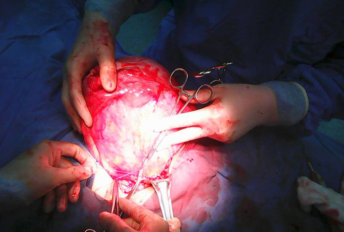 Bác sĩ cắt bỏ khối u nặng 2,8kg.