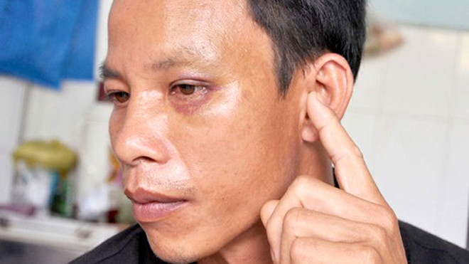 Anh Hồng bị thủng nhĩ tai trái, bầm mắt
