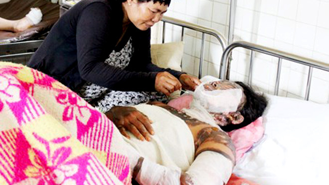 Chị A Sì Giá điều trị tại bệnh viện trong tình trạng bị bỏng nặng