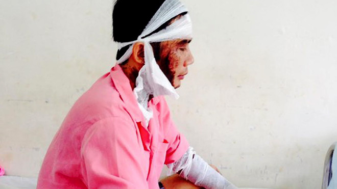 Anh Minh bị tạt axit khi vừa ra khỏi công ty