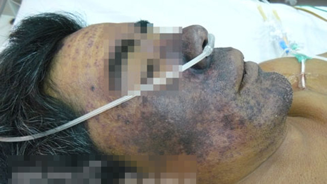 Người đàn ông này bị nhiễm liên cầu khuẩn do ăn tiết canh. Ảnh: BS Cấp cung cấp