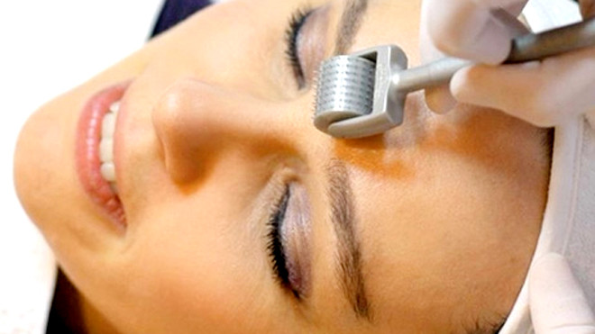 'Cơn sốt' làm đẹp bằng lăn kim