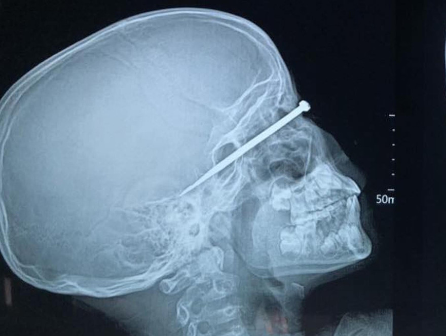 Dị vật đâm xuyên mắt em A.T. đã được lấy ra