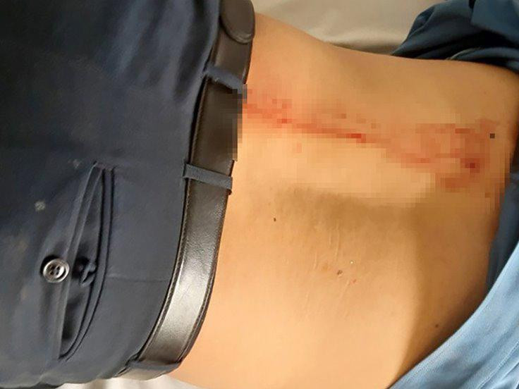 Anh Bình đang điều trị tại bệnh viện Đa khoa tỉnh Đắk Nông với vết thương sau lưng