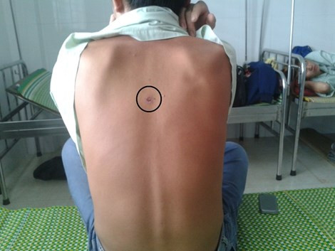 Vết thương trên lưng Nhân được cho là bị đạn cao su bắn trúng