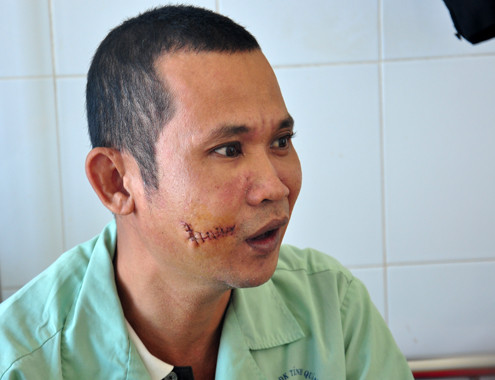 Anh Vương đang điều trị tại Bệnh viện đa khoa Quảng Ngãi. Ảnh: Trí Tín