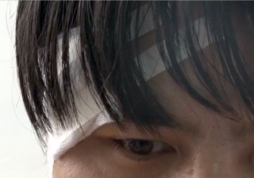 Một bác sĩ bị hành hung rách đầu. Ảnh: Báo Yên Bái