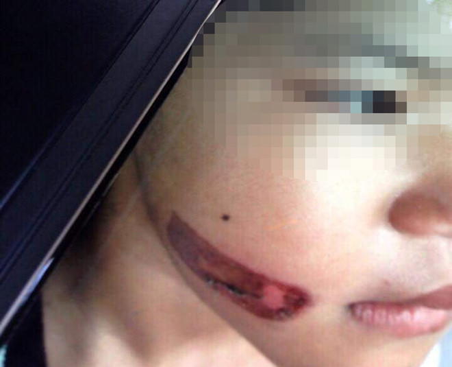 Vết bỏng trên mặt bé Thảo vào cuối tháng 11/2017