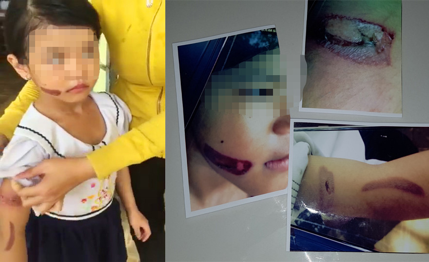 Vết thương ở tay và mặt cháu T.