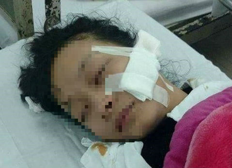 Nữ sinh Lan Anh bị đâm rách vùng mặt, kéo dài từ toàn bộ phần má đến mang tai