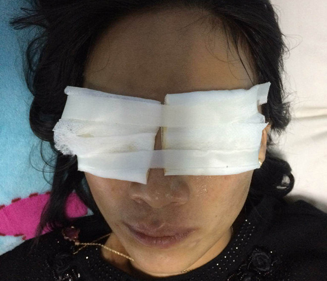 Nạn nhân bỏng 2 mắt do bị mẹ chồng tạt axit