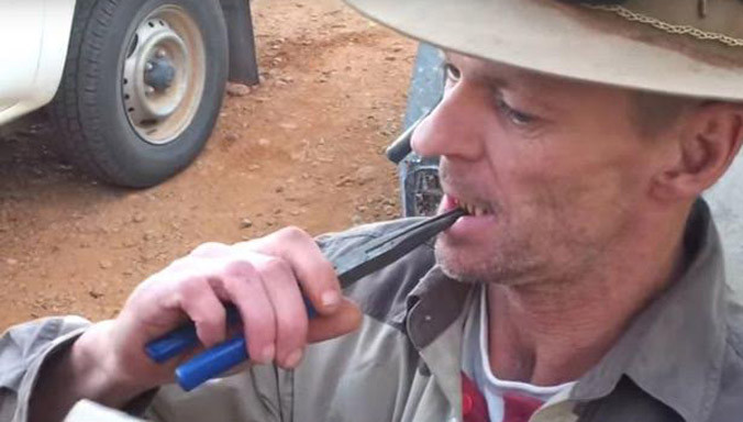 Người đàn ông đang dùng kìm kẹp chiếc răng có vấn đề.