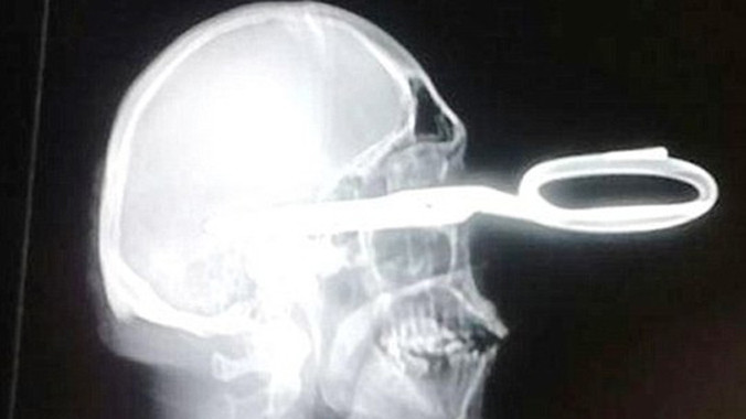 Hình chụp X-quang của Jonas Acevedo Monroy.