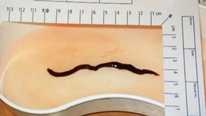 Con giun khổng lồ ẩn trong thận bà Hana Foldynova.