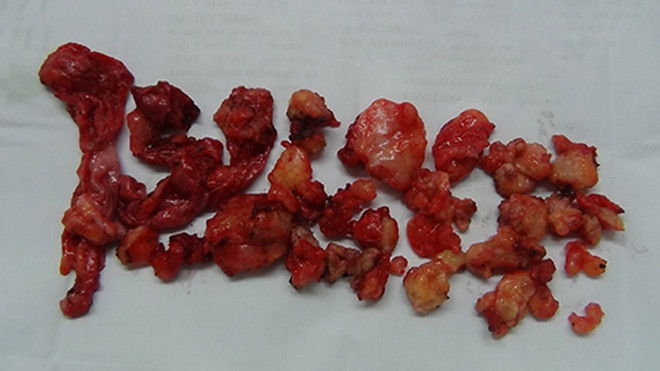 Trả giá vì bơm silicon nâng ngực