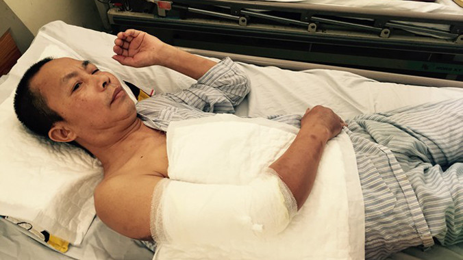 Cánh tay phải của bệnh nhân Hoàng Văn Nhân đã bị cắt đi phần da hoại tử.