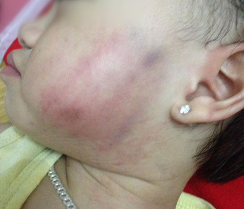 Vết bầm trên má bé 16 tháng tuổi khi gia đình đón về vào chiều 26/5.