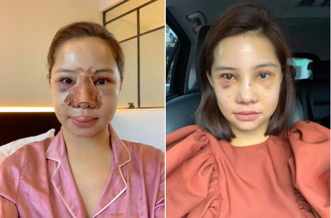 Nữ diễn viên đăng ảnh mặt sưng phồng sau dao kéo. Ảnh: FBNV. 