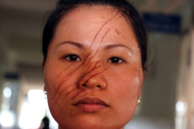 Thương tích của chị Vân