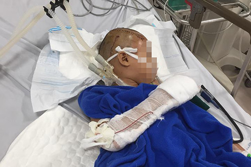 Bé trai qua cơn nguy kịch sau ca phẫu thuật kéo dài