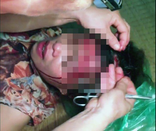 Bà Đào Thị Ph. khi cấp cứu khâu vết thương trên đầu