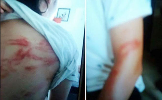 Vết thương của 2 cháu bé sau những trận đòn roi của bố. Ảnh: Gia đình cung cấp