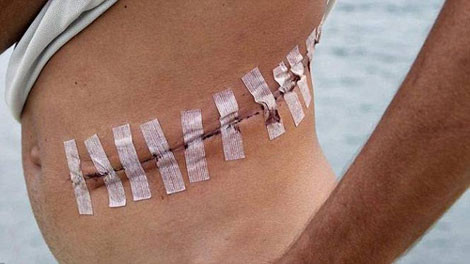 Một nạn nhân sau khi bị IS mổ lấy gan nhưng may mắn sống sót.