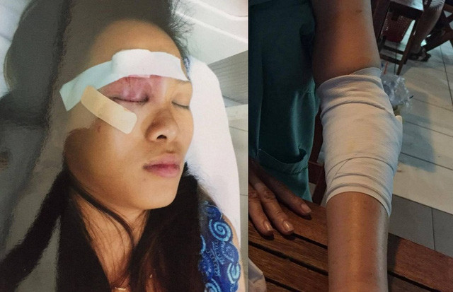 Chị Tuyết với vết thương ở vùng mặt và cánh tay bị gãy của bà Thủy
