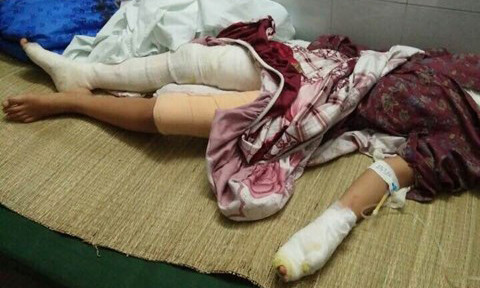 Cháu bé bị bỏng nặng, hiện đang được điều trị tại Viện Bỏng Quốc gia