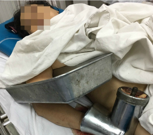 Bệnh nhân vào cấp cứu với máy xay thịt. Ảnh: H.K.