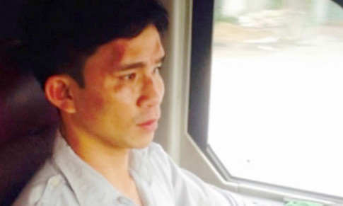 Tài xế Hùng bị đánh thâm tím vùng măt, đầu. Ảnh: Ngọc Ngọc