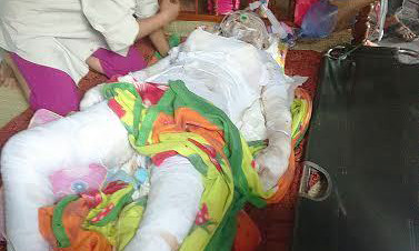 Chị Đàm bị phỏng nặng toàn thân. Ảnh: Thái Cao