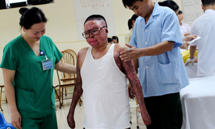 Thượng úy Đinh Văn Dương đang tập những bước đi đầu tiên với đôi chân giả. Ảnh: Mộc Miên