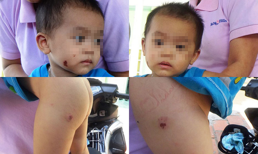 Bé trai 19 tháng tuổi nghi bị đánh bầm dập