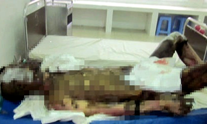 Đinh Văn Huấn khi đang được cấp cứu tại bệnh viện