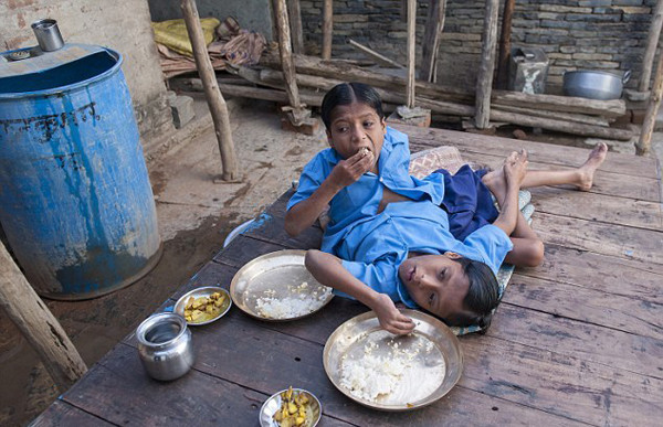 Cuộc sống của cặp song sinh dính liền nhau 