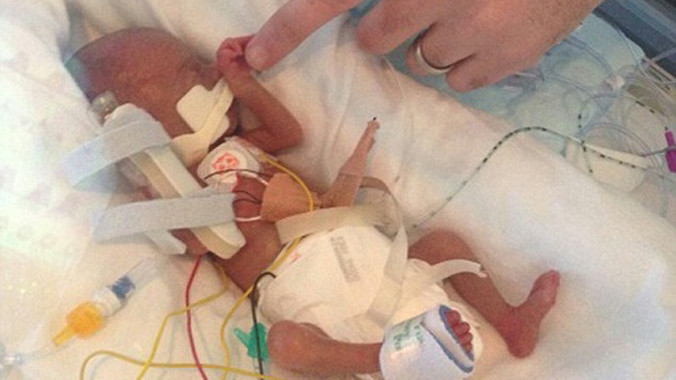 Bé Mollie chào đời thiếu tháng, chỉ nặng chưa đầy 0,5 kg. Ảnh: Health.