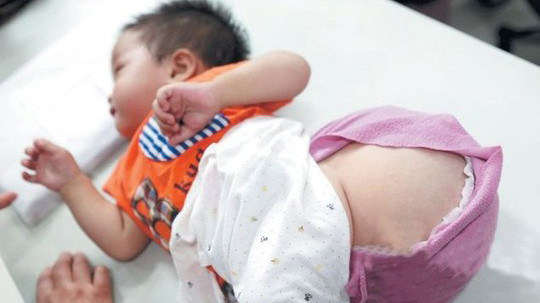 Khi ra đời, khối u trên người bé chỉ nhỏ bằng quả nho nhưng do không có tiền chữa trị, khối u lớn dần