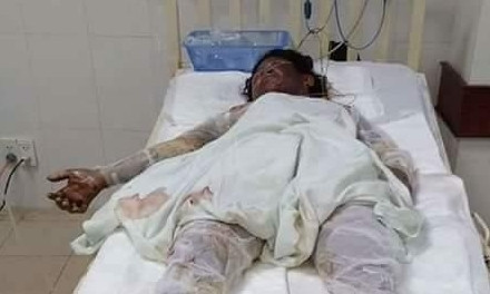 Một nạn nhân bị bỏng trong vụ tự thiêu lúc còn đang nằm viện điều trị.