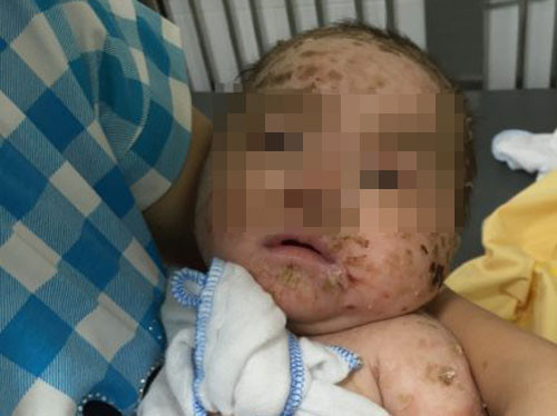 Sau 5 ngày được chăm sóc, tổn thương của trẻ đã khô và bong vảy